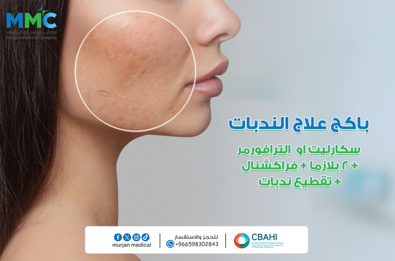 باكج علاج الندبات(سكارليت او الترافورمر+2بلازما +فراكشنال +تقطيع ندبات